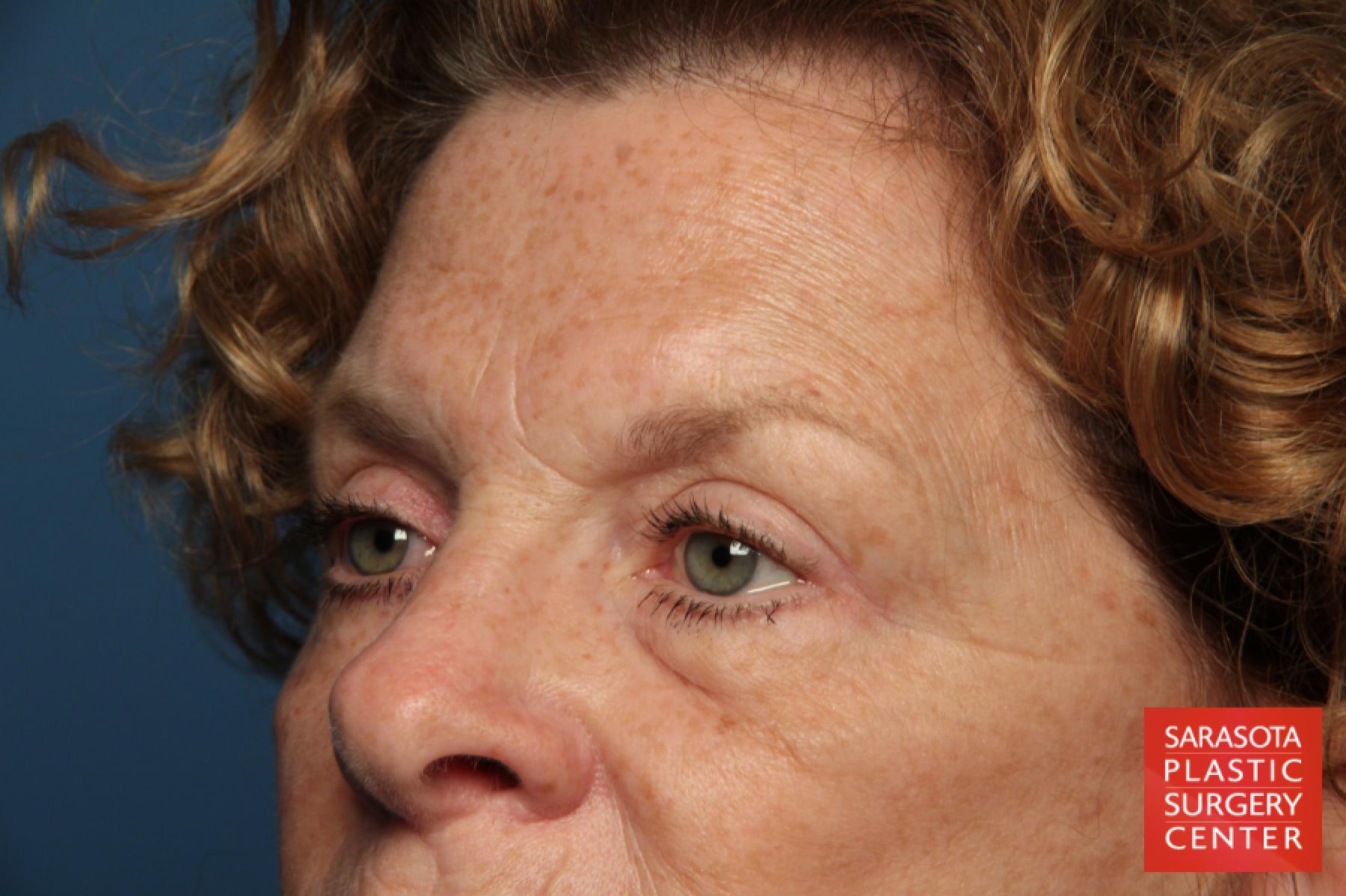 Eyelid Lift: Patient 25 - Before 4