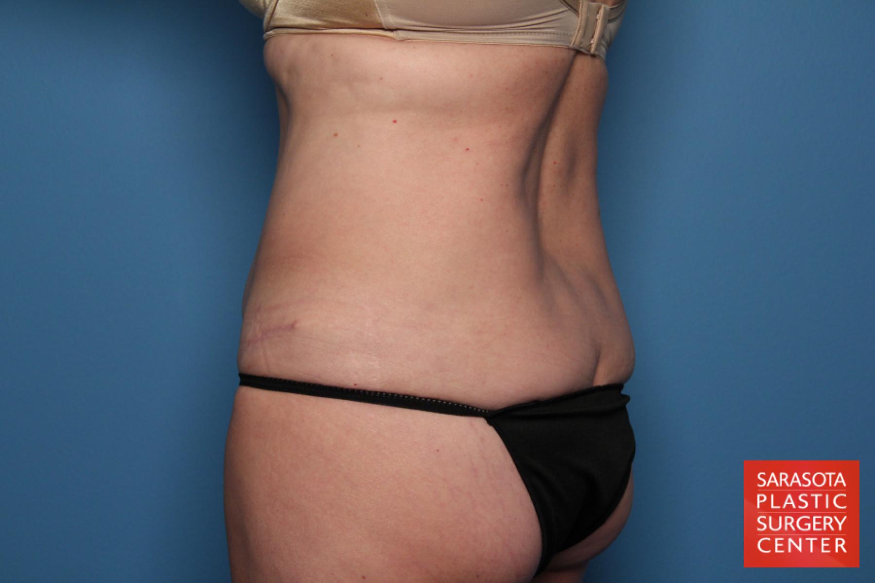 Tummy Tuck: Patient 18 - After 4