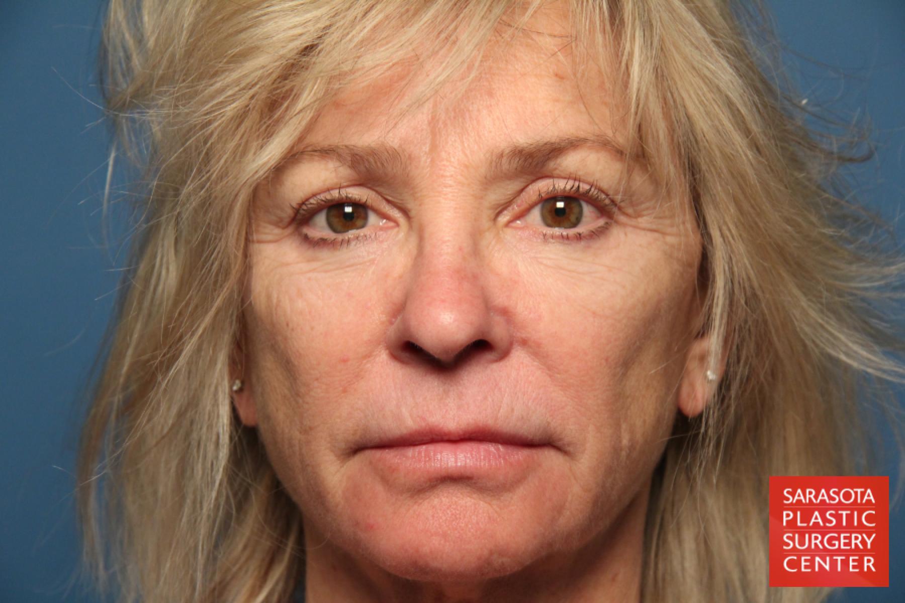 Laser Skin Resurfacing - Face: Patient 9 - Before 