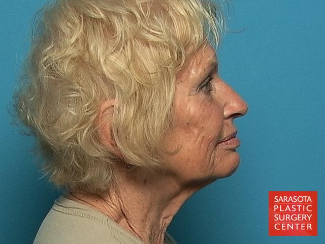 Cheek Lift: Patient 3 - Before and After 3