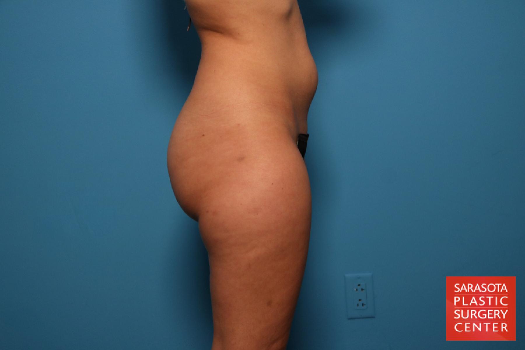 Liposuction: Patient 13 - Before 3
