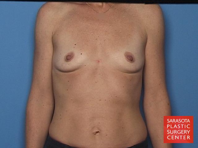 Breast Augmentation: Patient 35 - Before 1