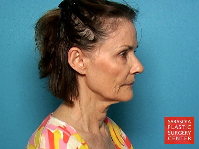 Facelift: Patient 36 - Before and After 3
