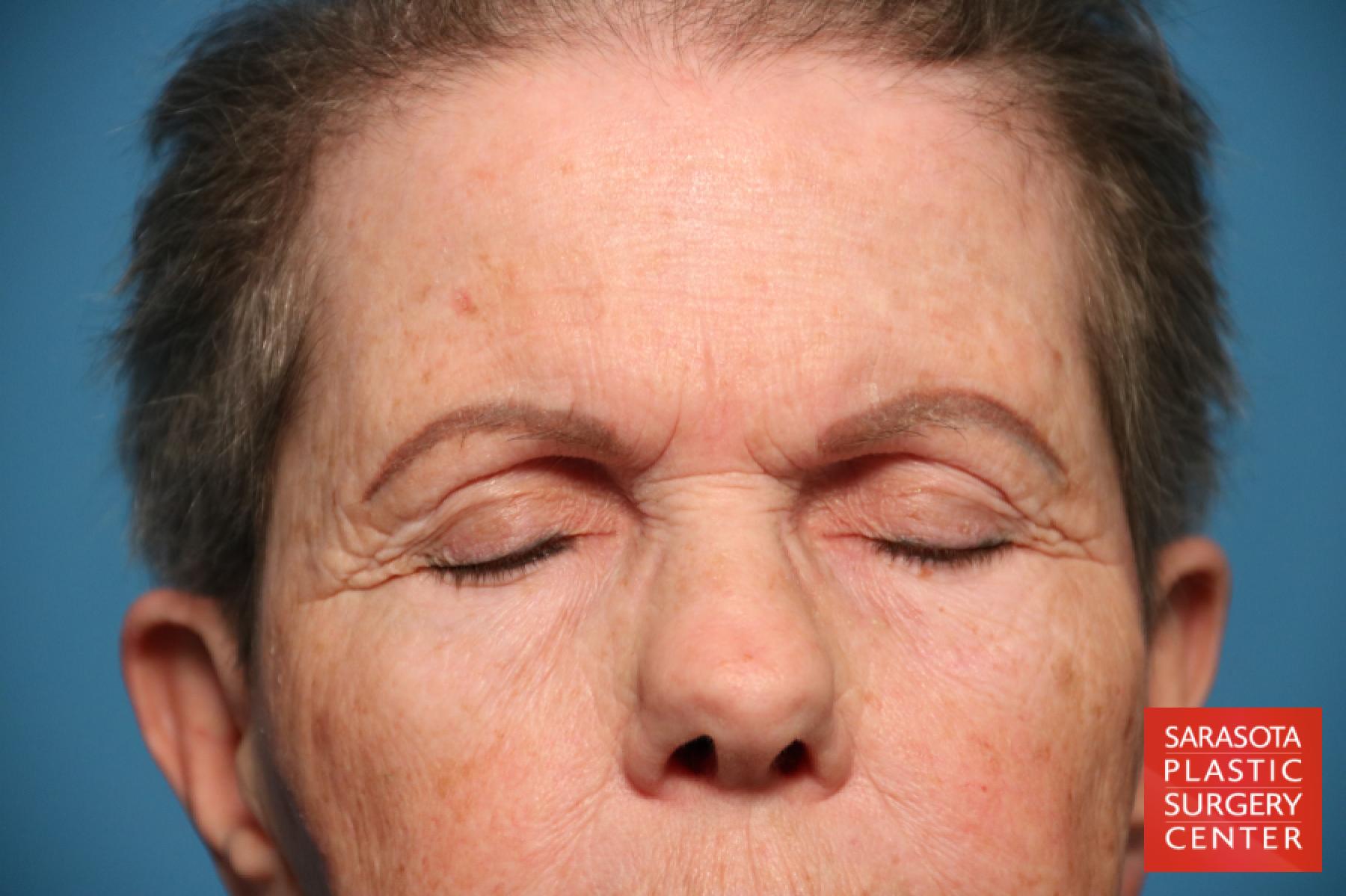 Eyelid Lift: Patient 29 - Before 2