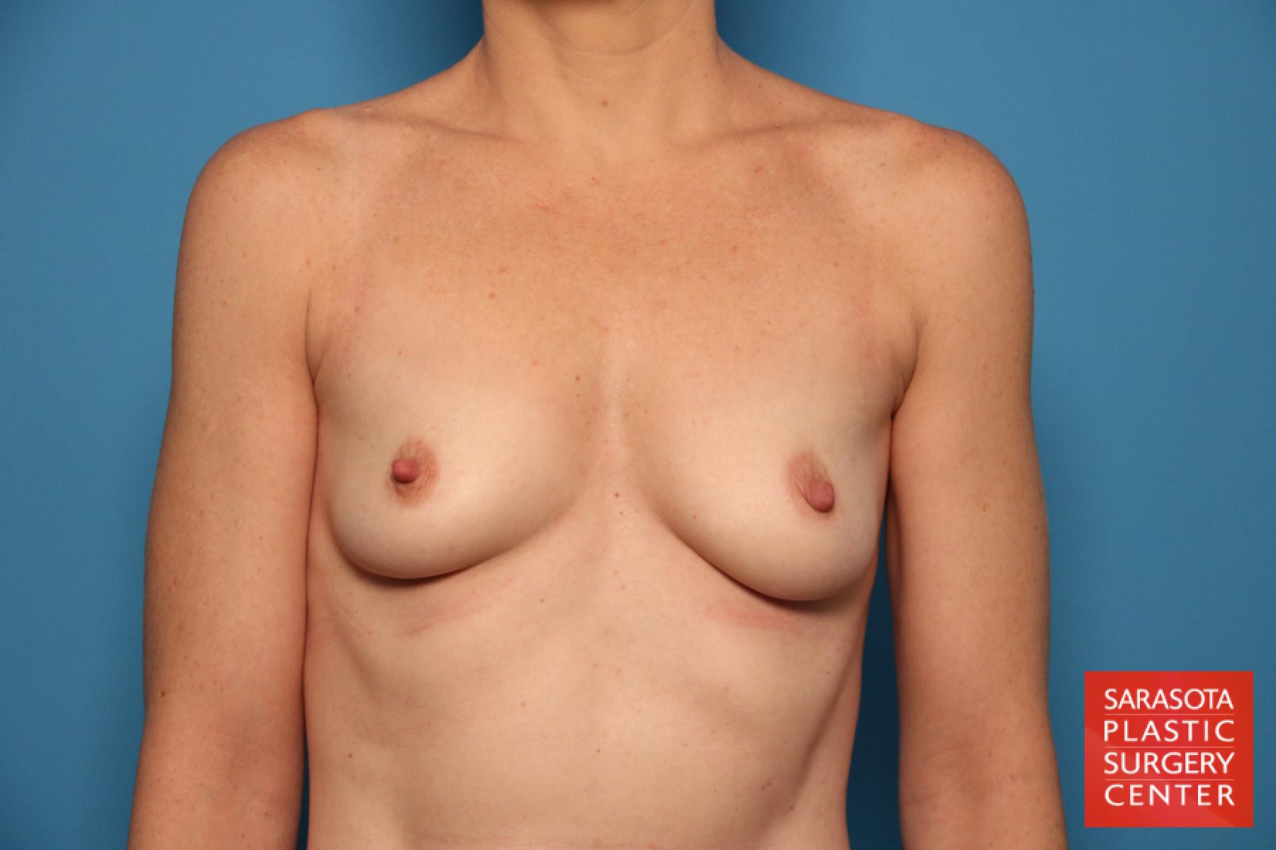Breast Augmentation: Patient 7 - Before 
