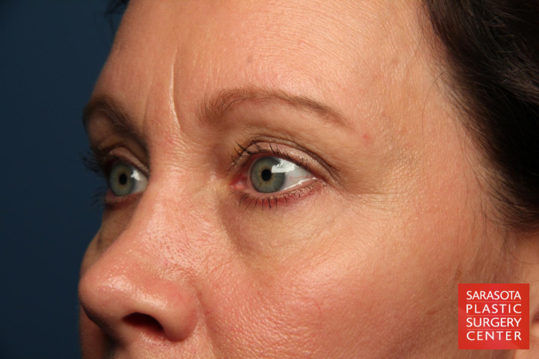 Eyelid Lift: Patient 40 - Before 2