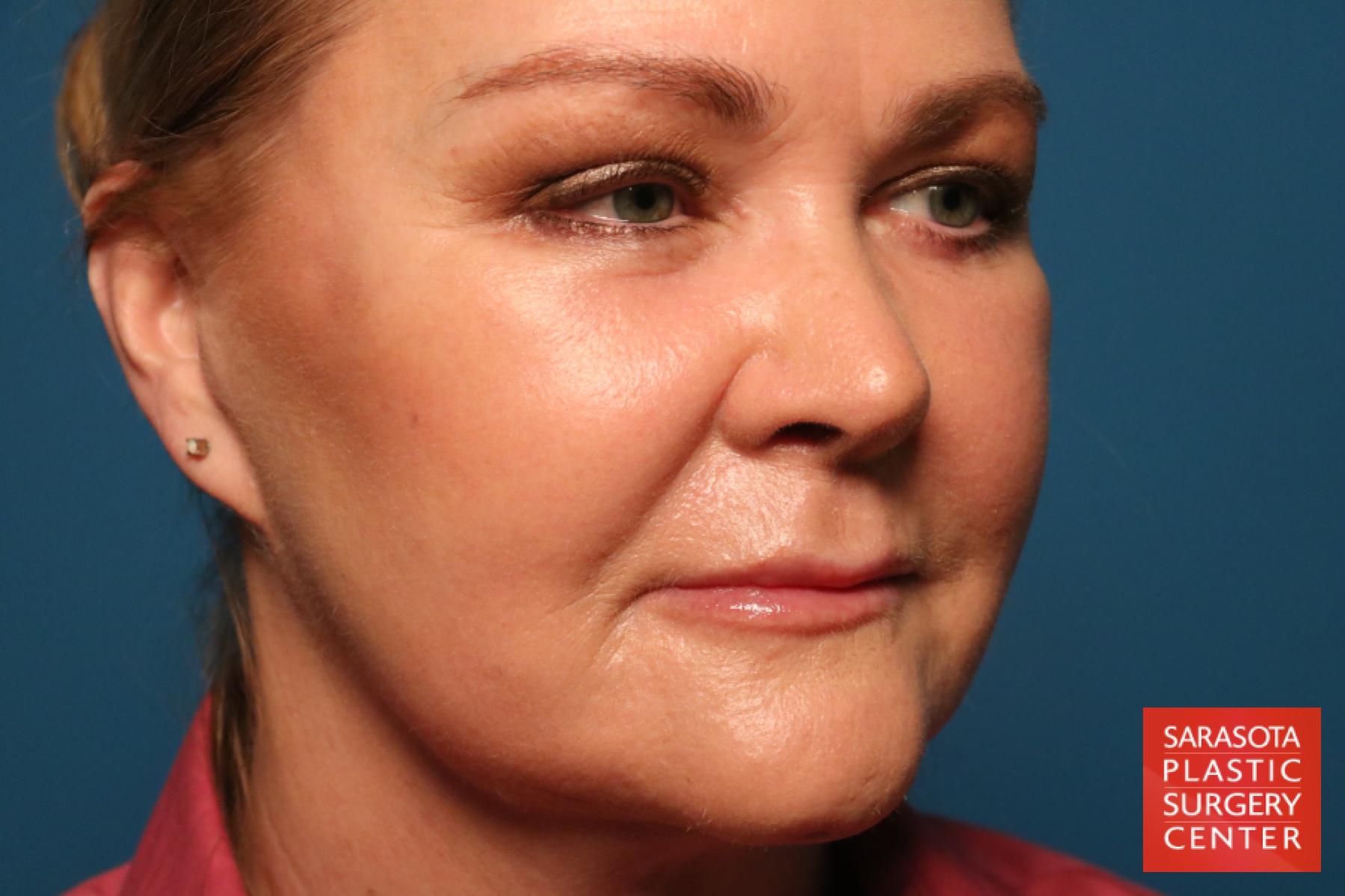 Laser Skin Resurfacing - Face: Patient 17 - After 3