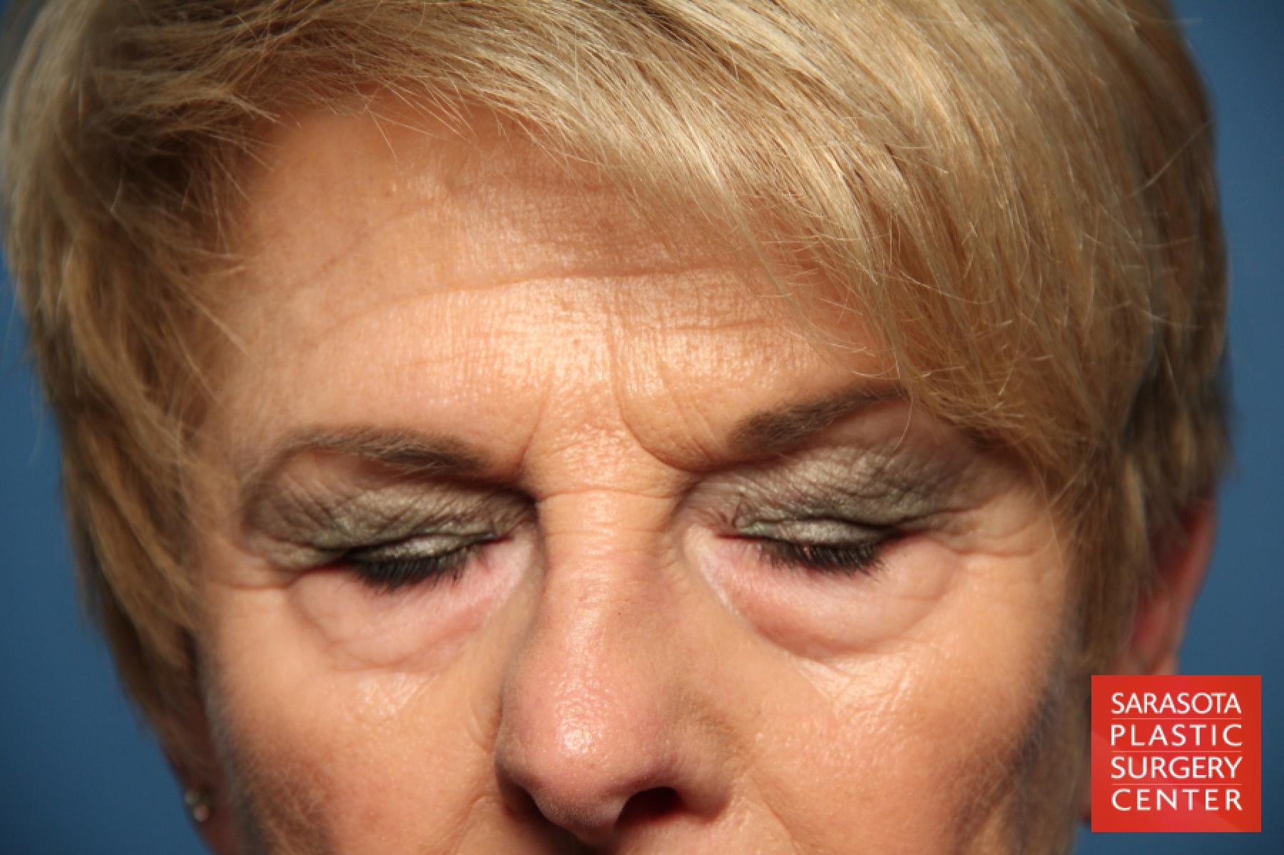 Eyelid Lift: Patient 11 - Before 3