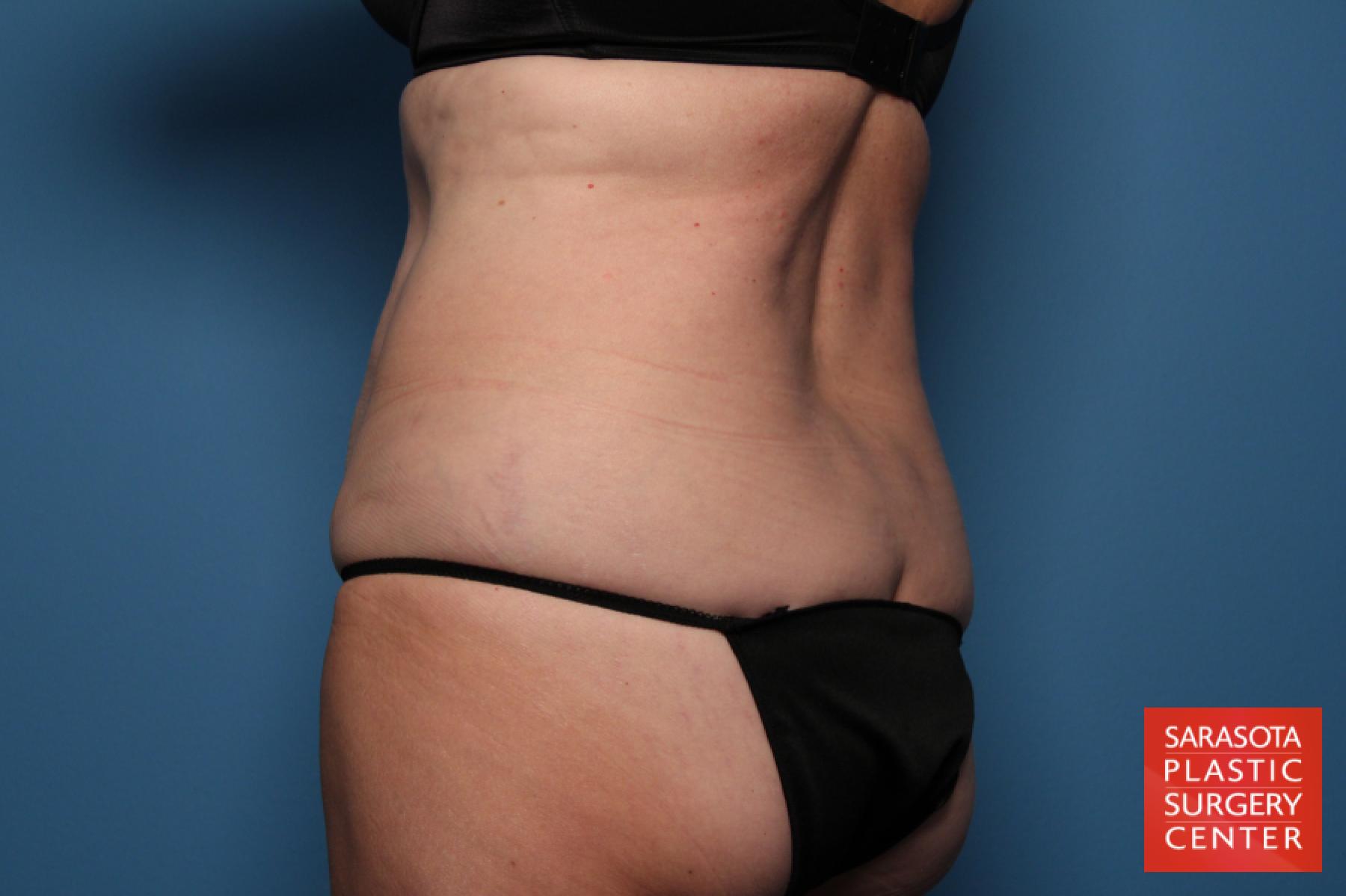 Tummy Tuck: Patient 18 - Before 4
