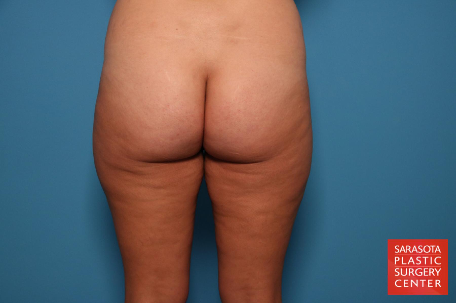 Liposuction: Patient 7 - Before 5
