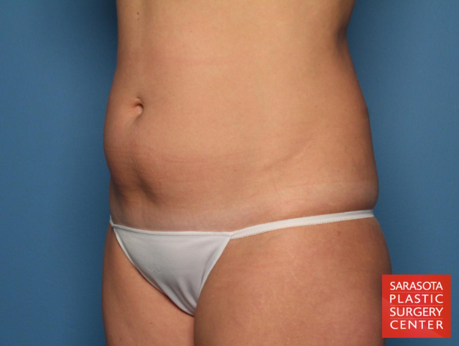 Tummy Tuck: Patient 20 - Before 2