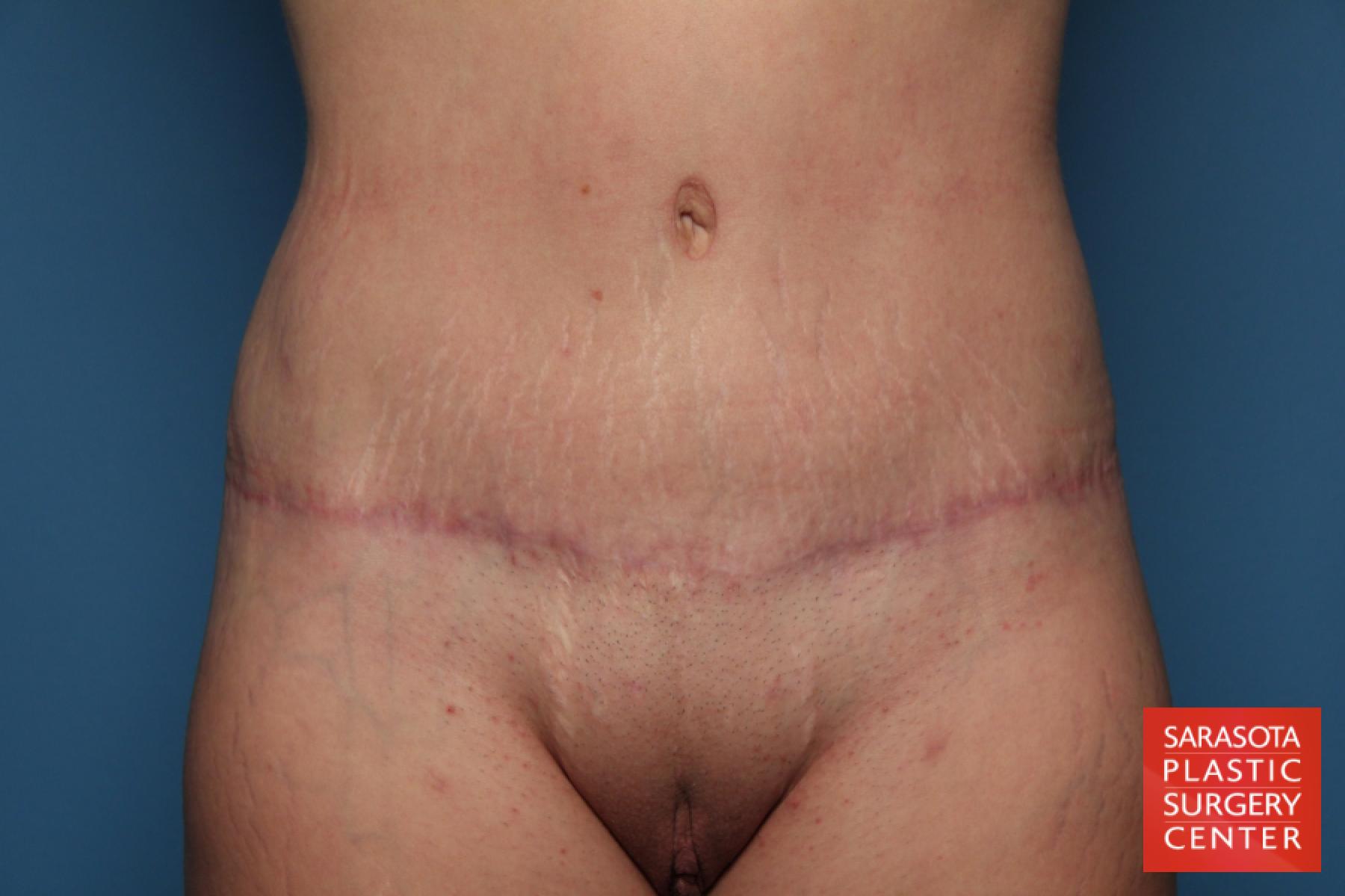 Tummy Tuck: Patient 21 - After 1