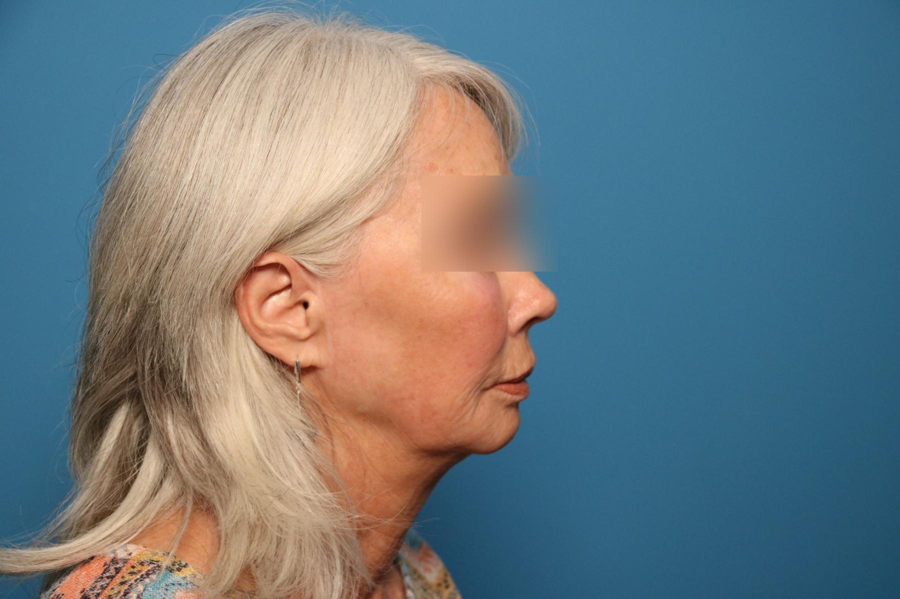 Facelift/Mini Facelift: Patient 3 - Before and After 3