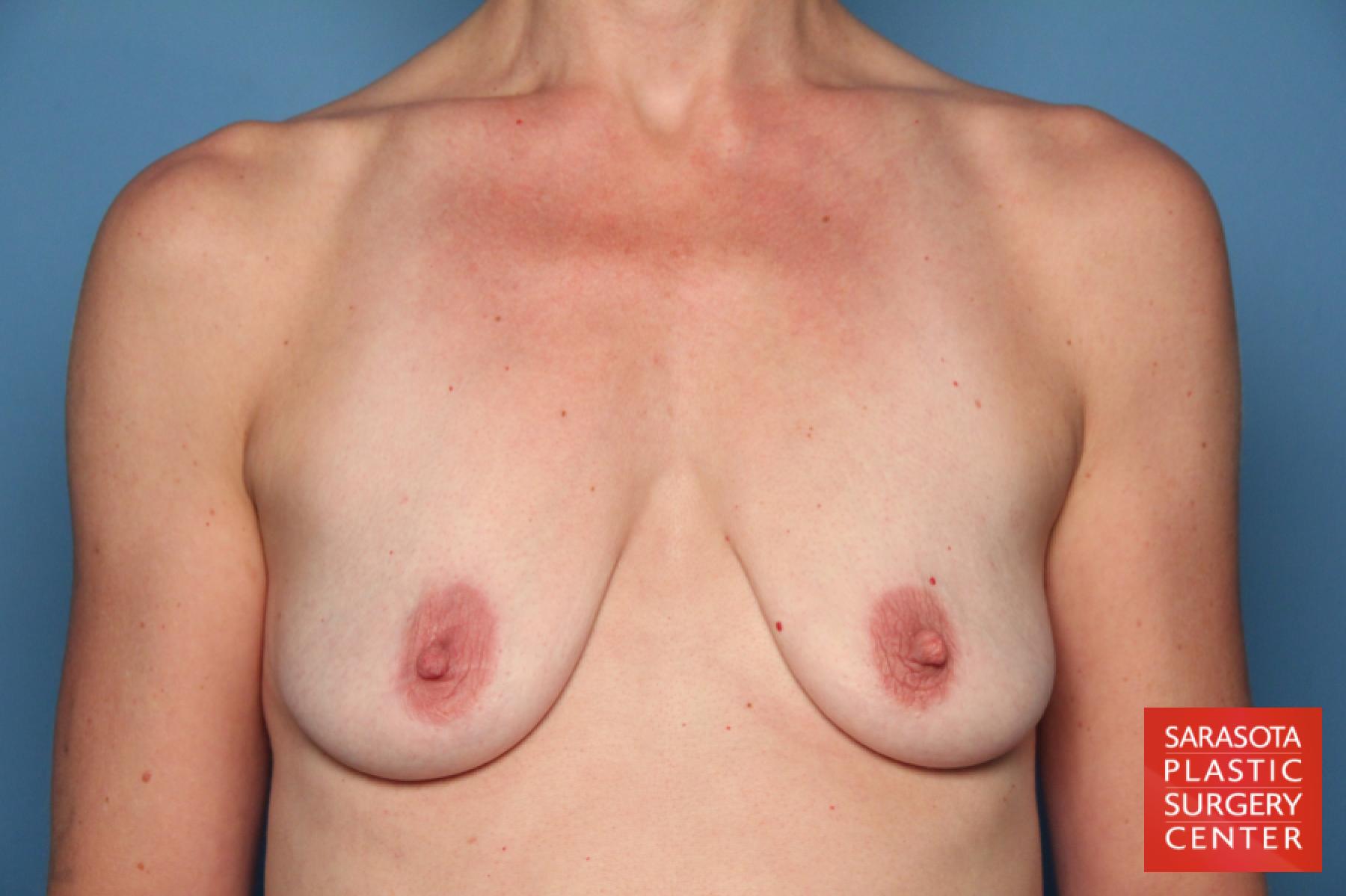 Breast Augmentation With Lift: Patient 27 - Before 1