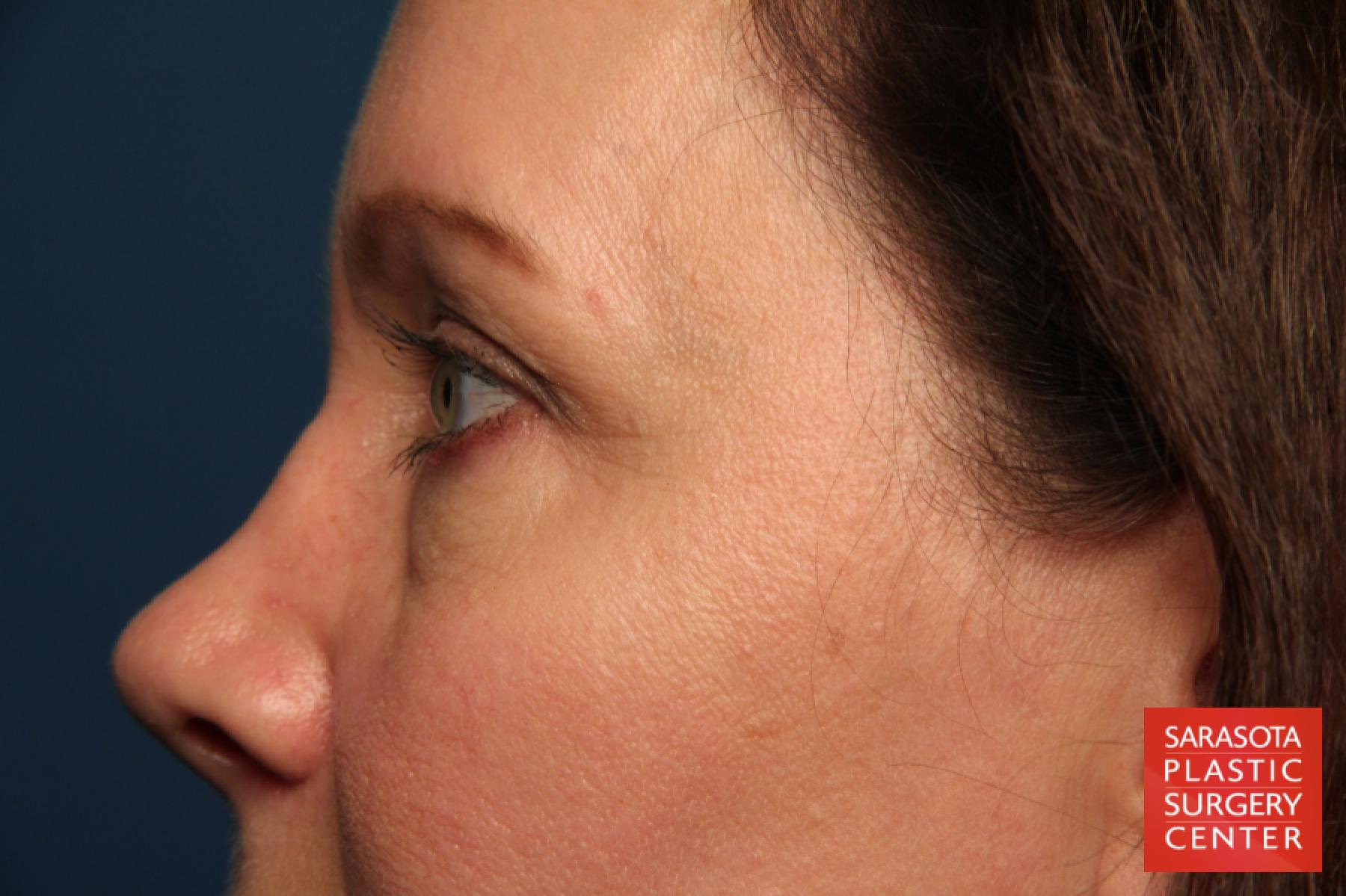 Eyelid Lift: Patient 40 - Before 3