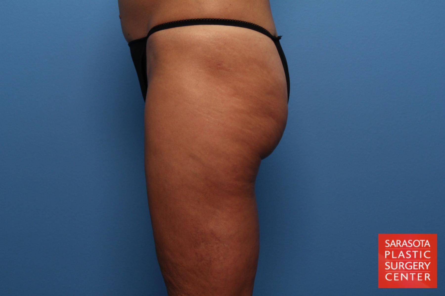 Liposuction: Patient 3 - After 3