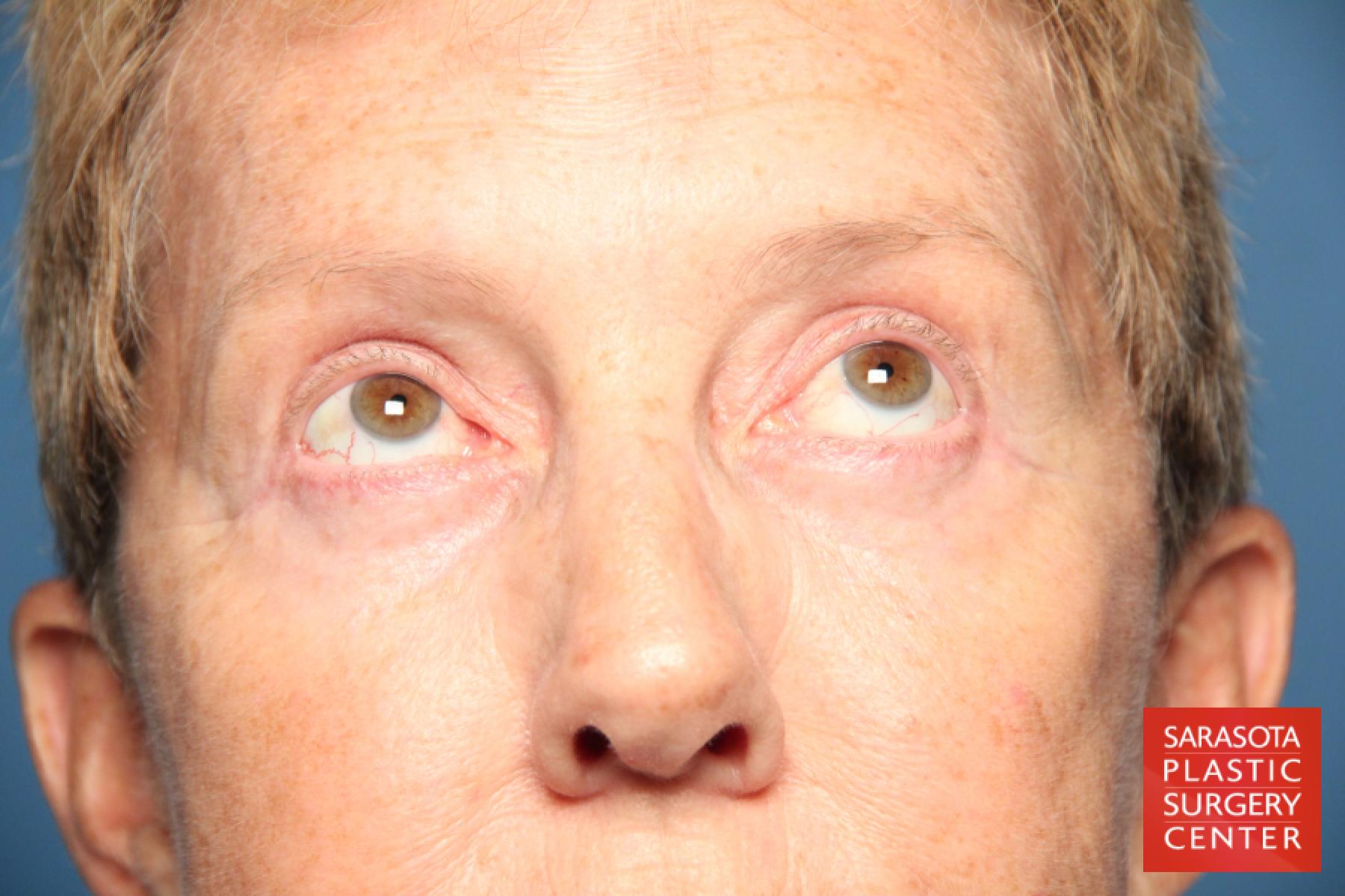 Eyelid Lift: Patient 22 - After 3