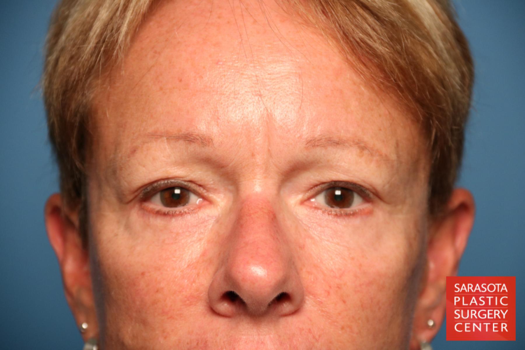 Eyelid Lift: Patient 18 - After 1