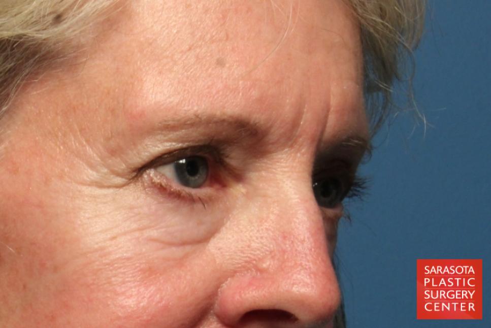 Eyelid Lift: Patient 32 - Before 2