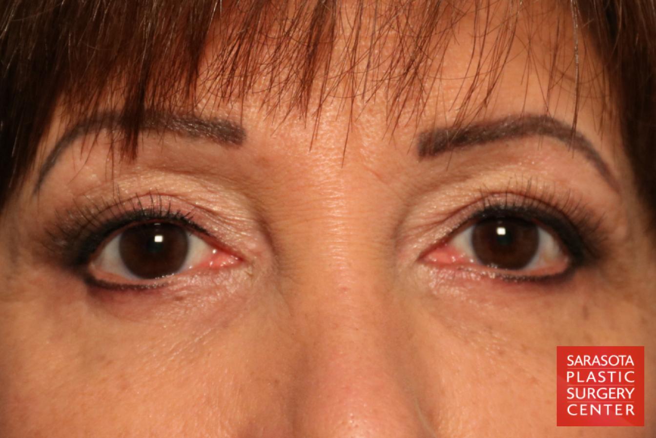 Eyelid Lift: Patient 9 - After 1