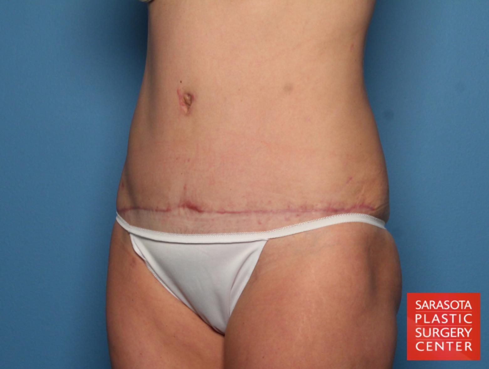 Tummy Tuck: Patient 20 - After 2