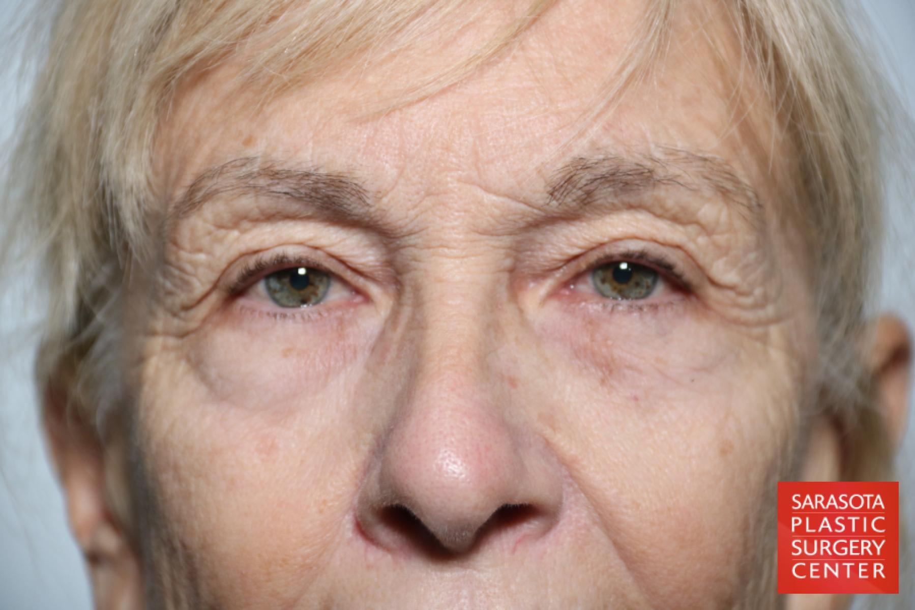 Eyelid Lift: Patient 43 - Before 1