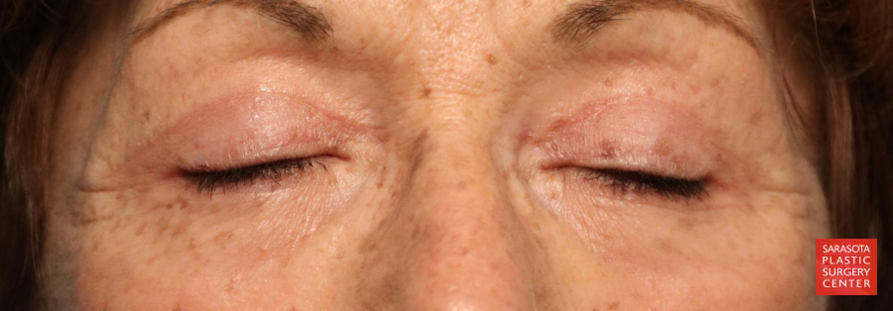 Eyelid Lift: Patient 6 - After 3
