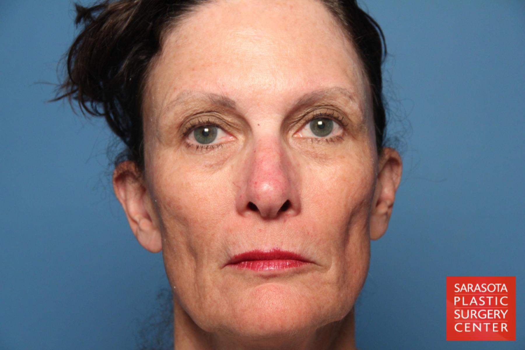 Fat Transfer - Face: Patient 5 - Before 