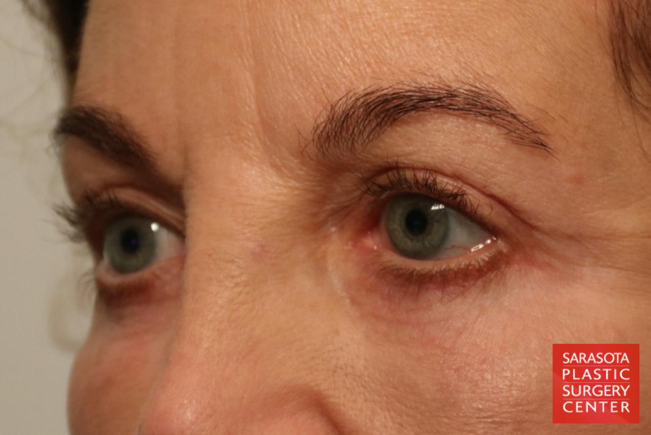 Eyelid Lift: Patient 39 - After 3