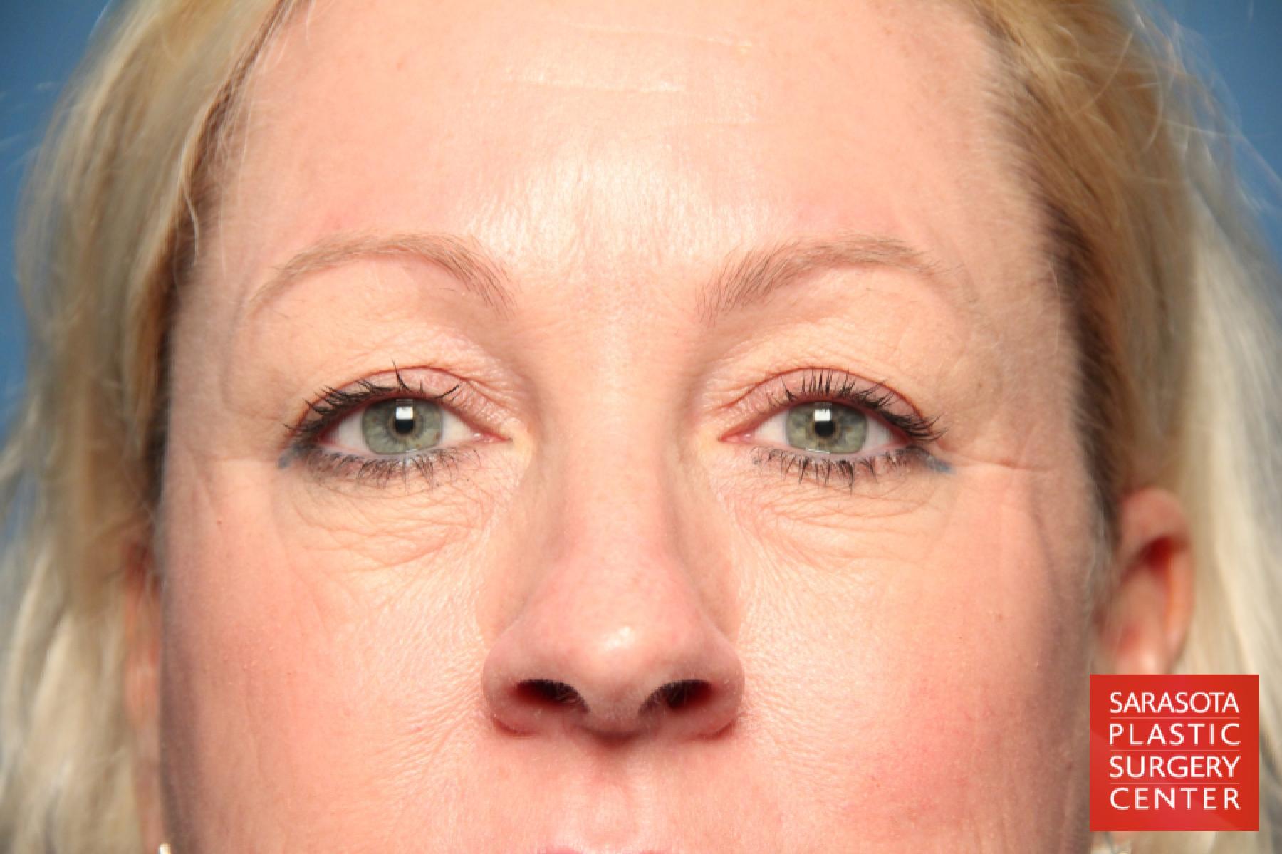 Eyelid Lift: Patient 4 - Before 1
