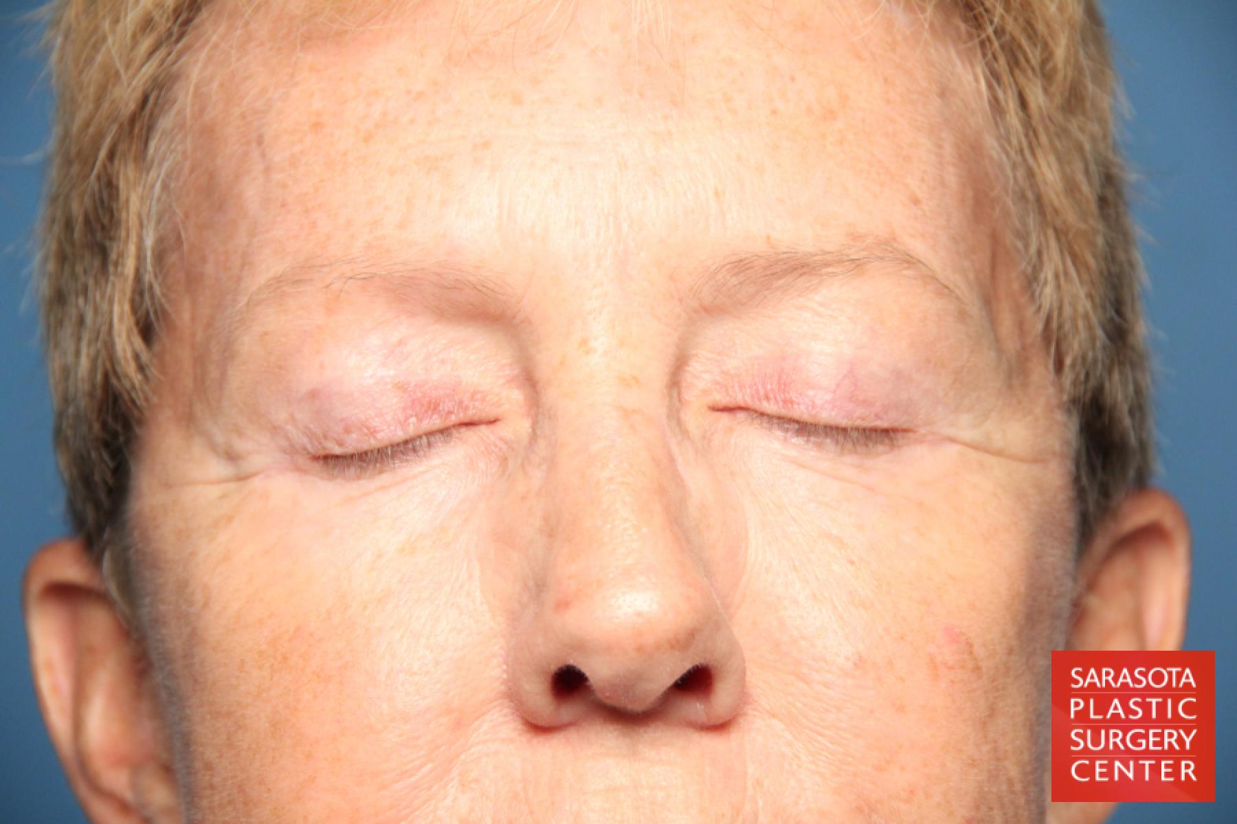 Eyelid Lift: Patient 22 - After 2