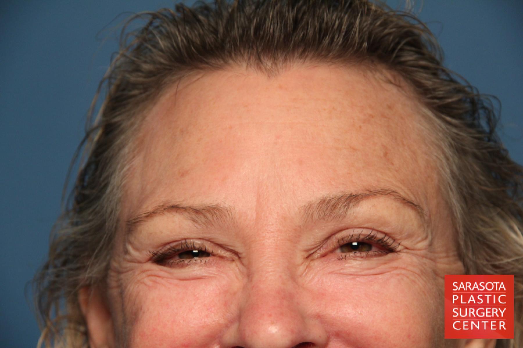Laser Skin Resurfacing - Face: Patient 9 - After 5