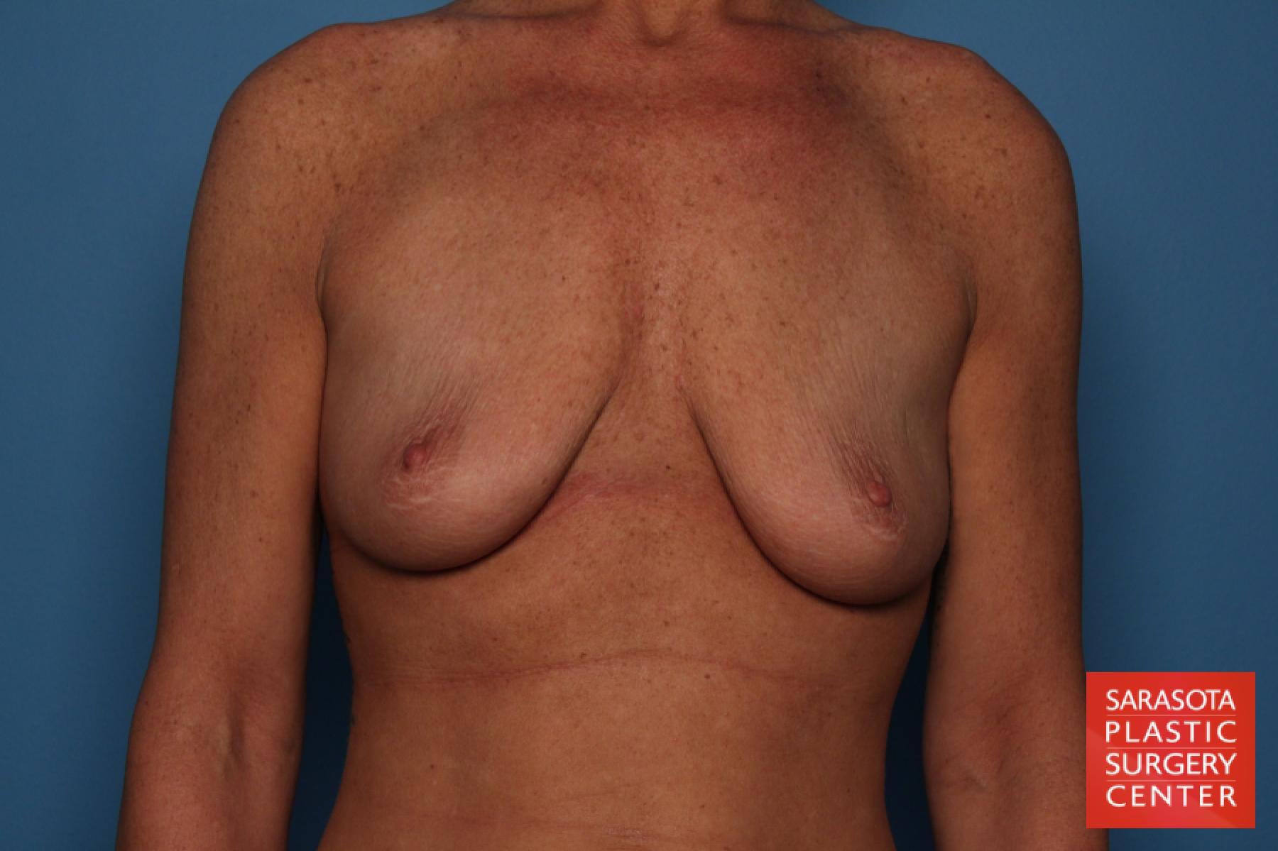 Breast Augmentation With Lift: Patient 26 - Before 1