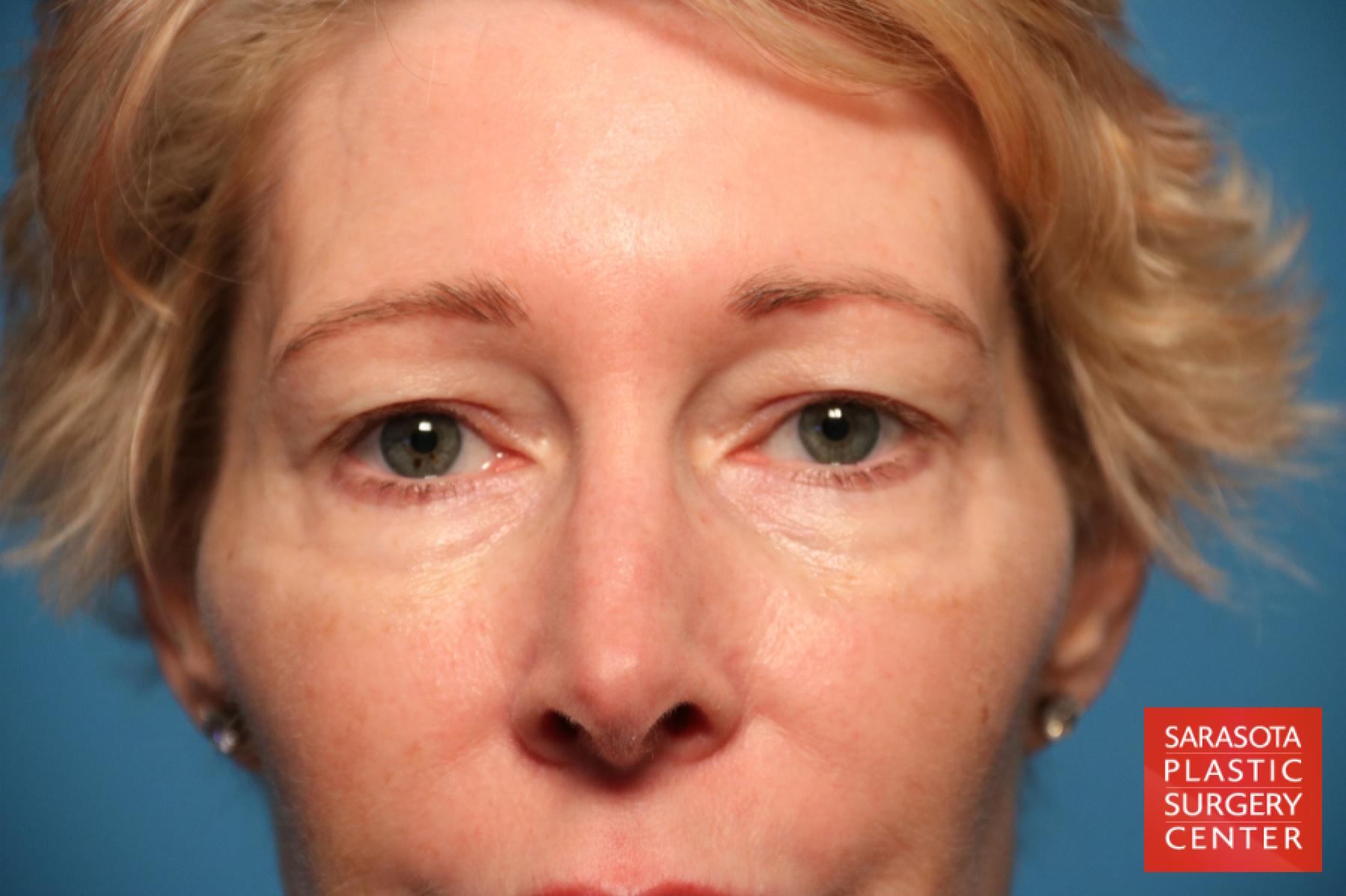 Eyelid Lift: Patient 12 - Before 1