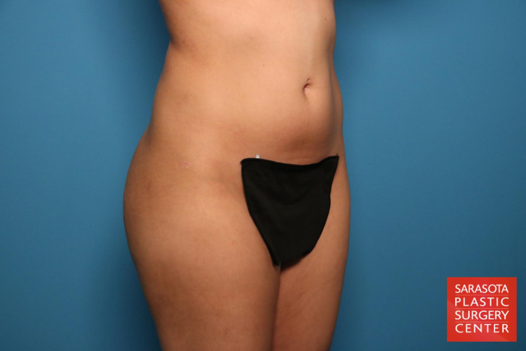 Liposuction: Patient 15 - After 5