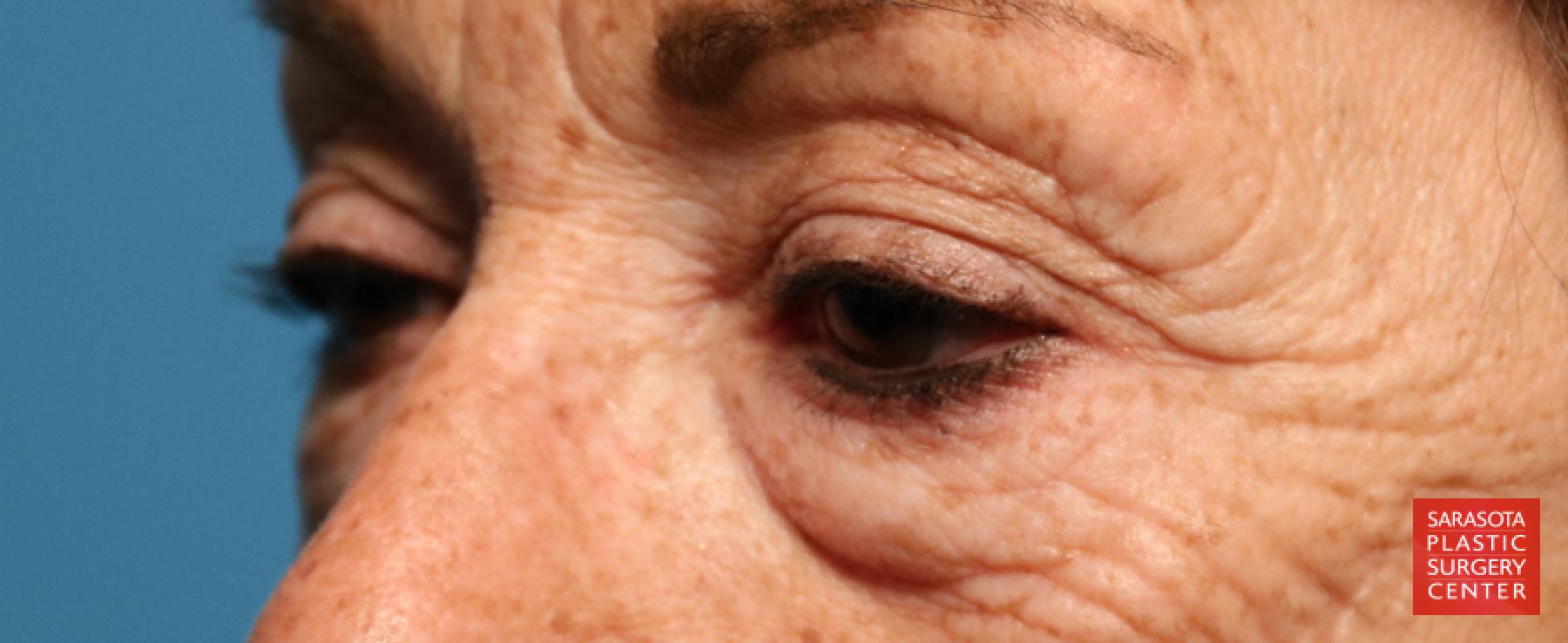 Eyelid Lift: Patient 7 - Before 4