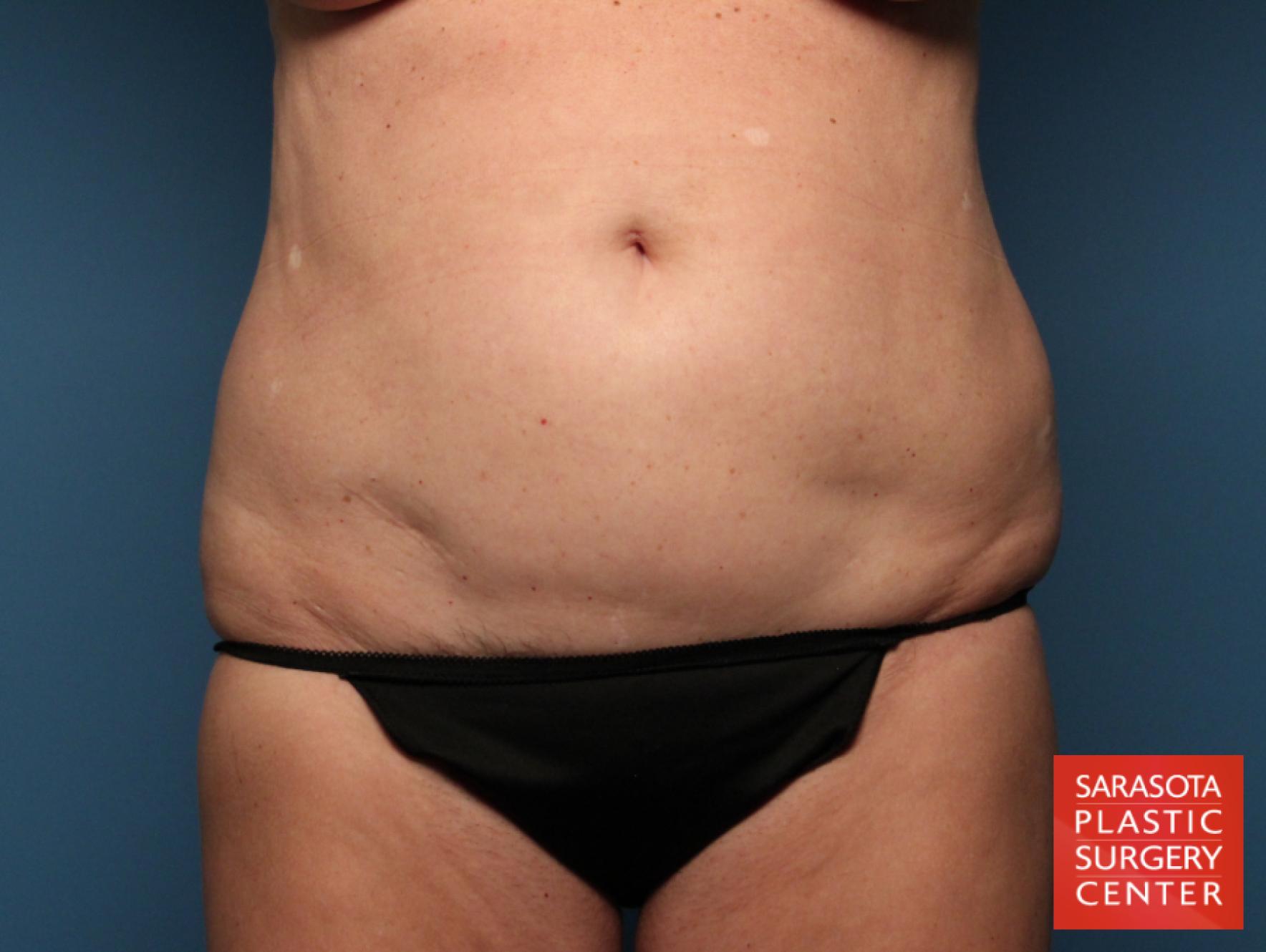 Tummy Tuck: Patient 19 - Before 1