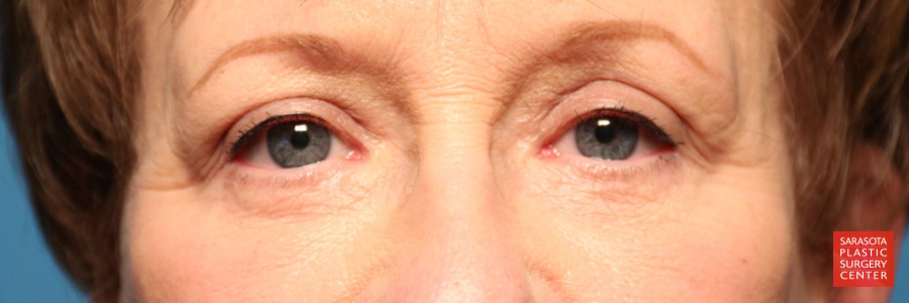 Eyelid Lift: Patient 20 - After 1