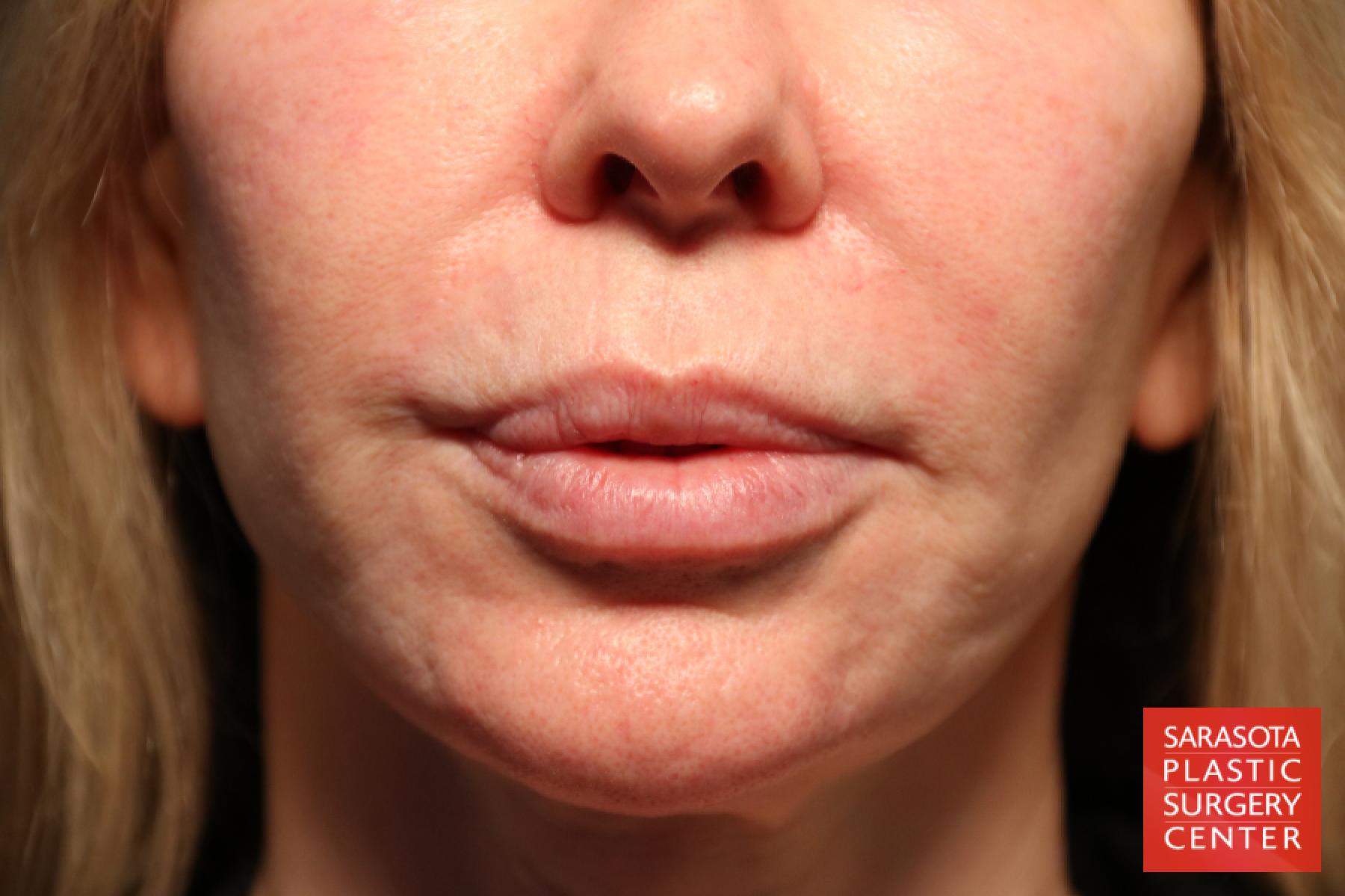 Laser Skin Resurfacing - Face: Patient 7 - Before 