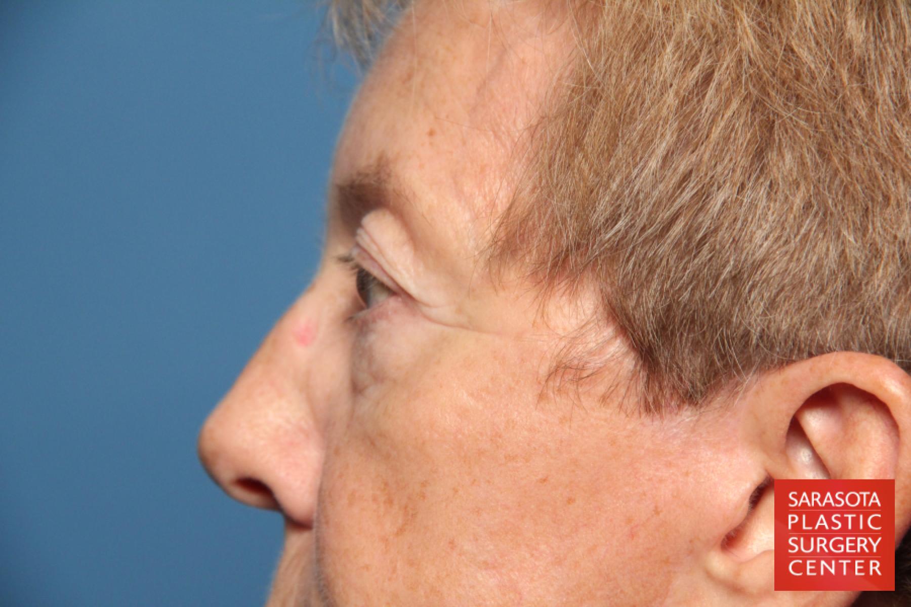 Eyelid Lift: Patient 22 - Before and After 5