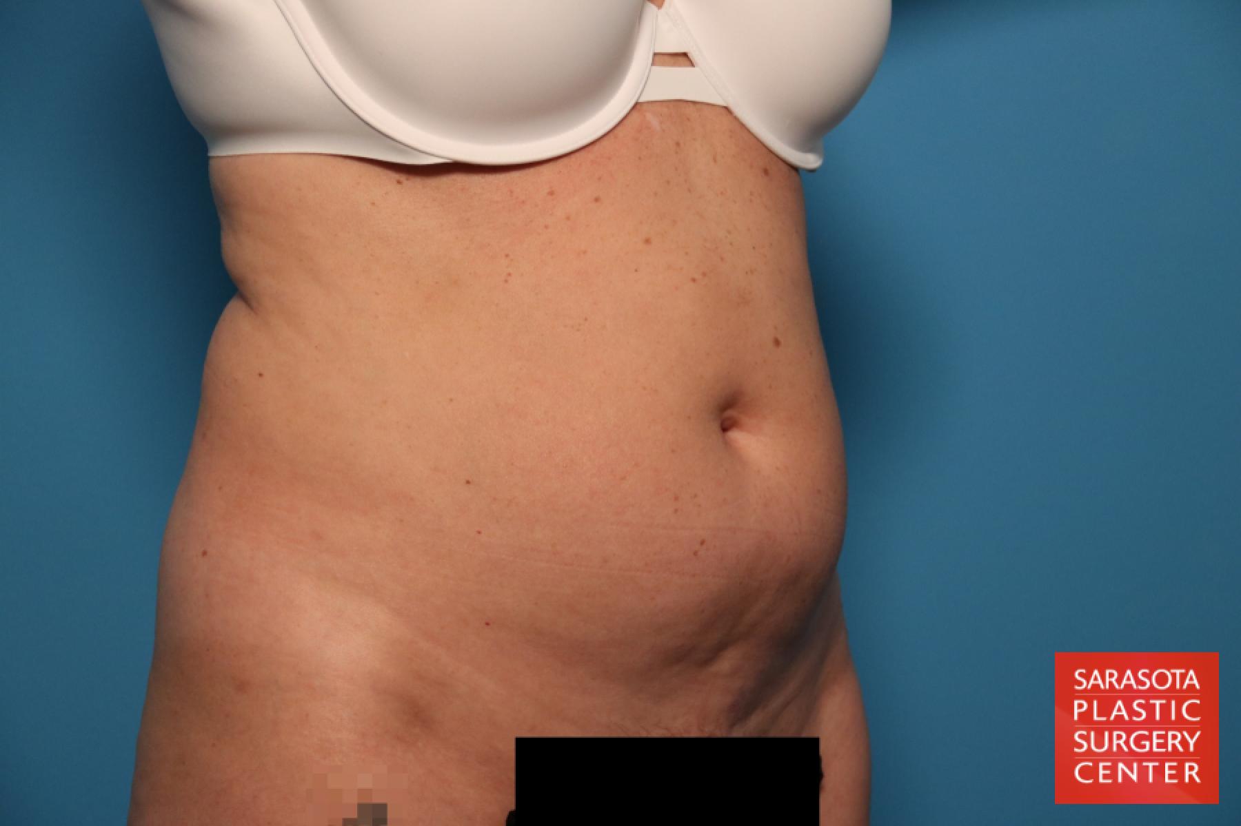 Tummy Tuck: Patient 22 - Before 2