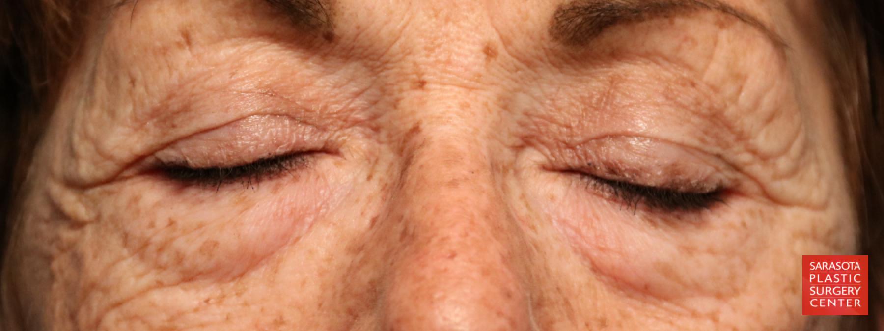 Eyelid Lift: Patient 7 - Before 3