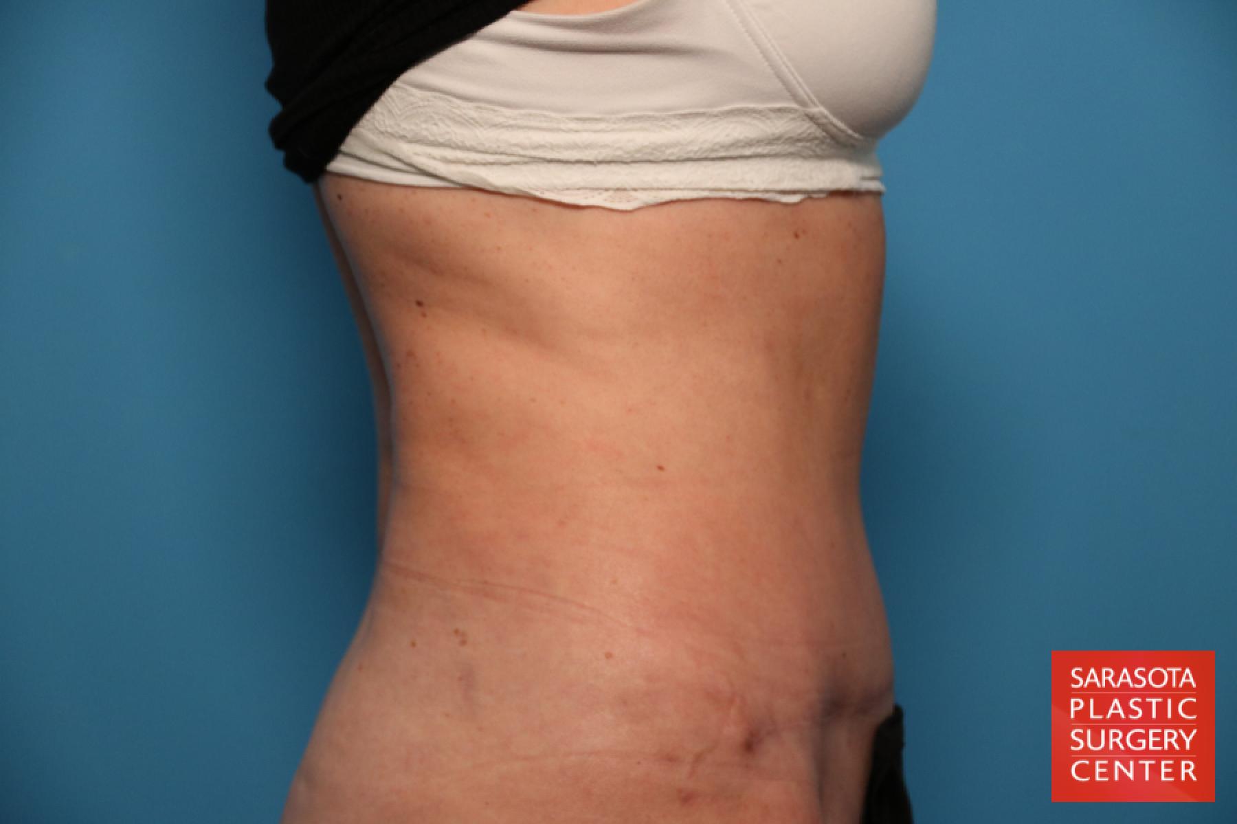 Tummy Tuck: Patient 22 - After 3