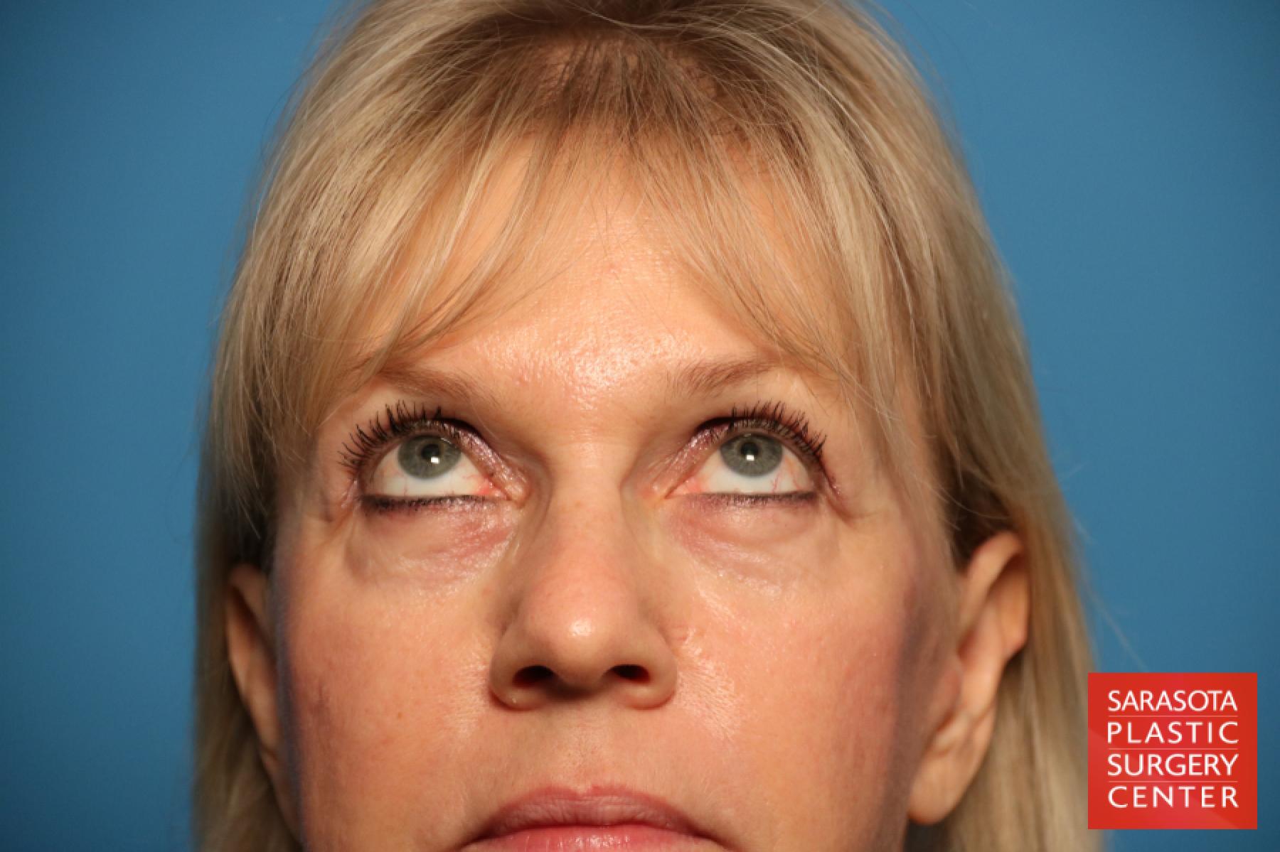 Eyelid Lift: Patient 7 - Before 3