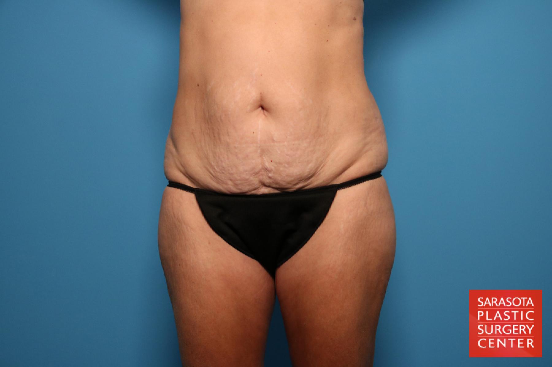 Tummy Tuck: Patient 13 - Before 1