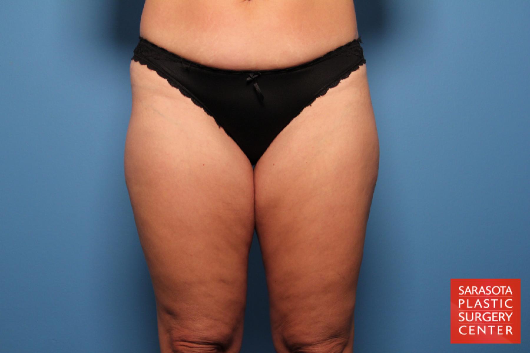 Liposuction: Patient 6 - Before 1