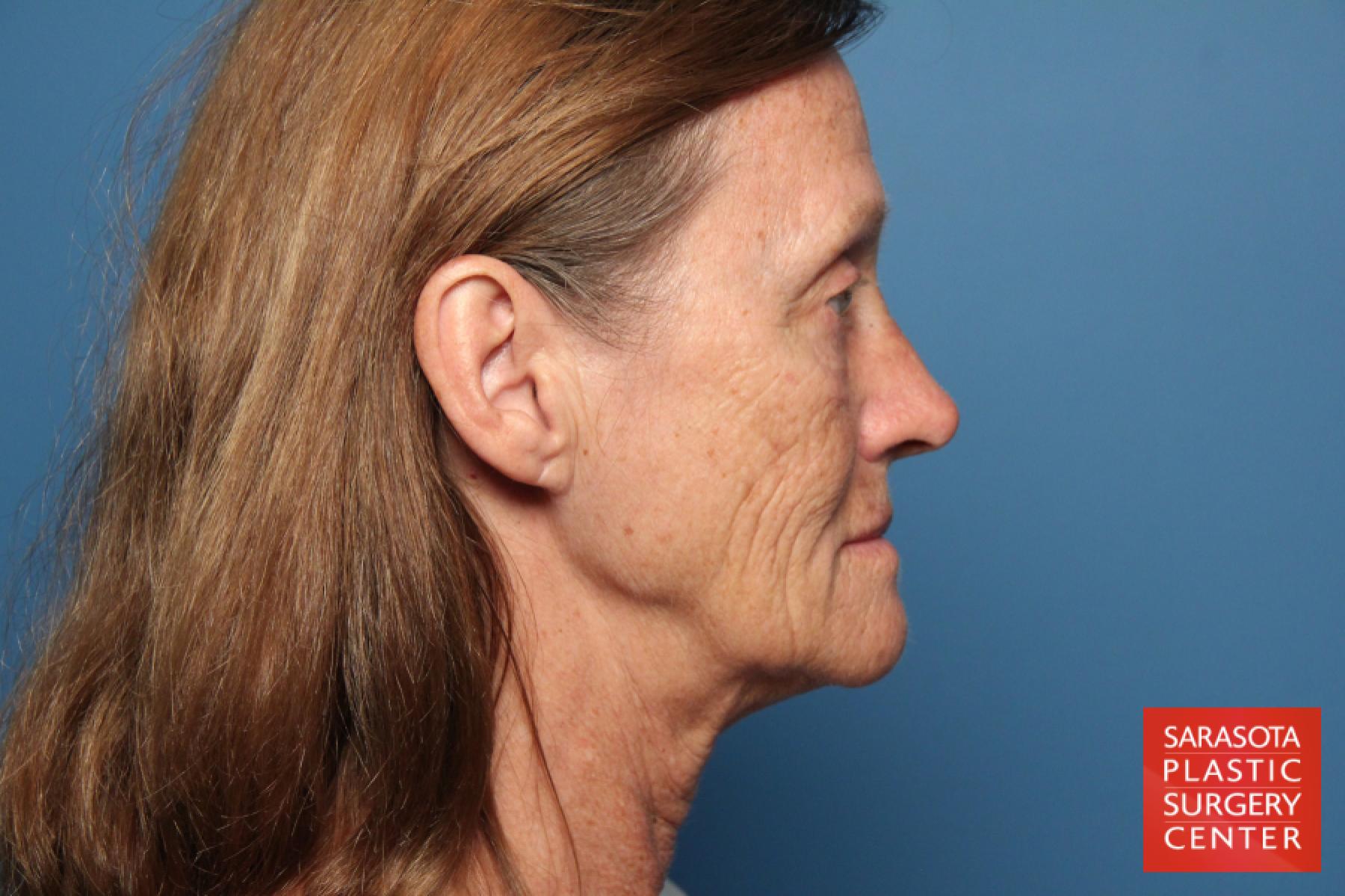 Laser Skin Resurfacing - Face: Patient 11 - Before and After 3