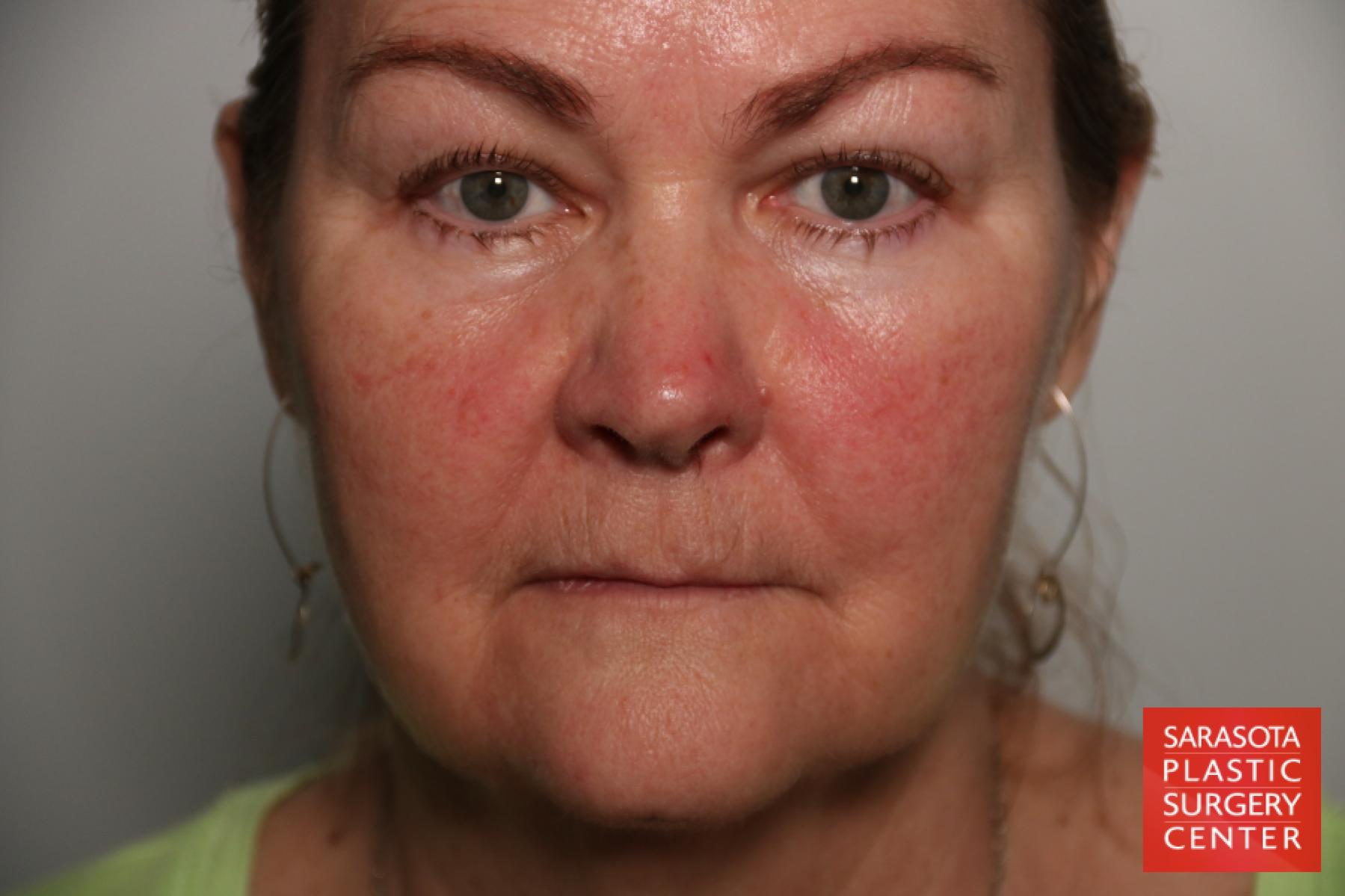 Laser Skin Resurfacing - Face: Patient 17 - Before 1