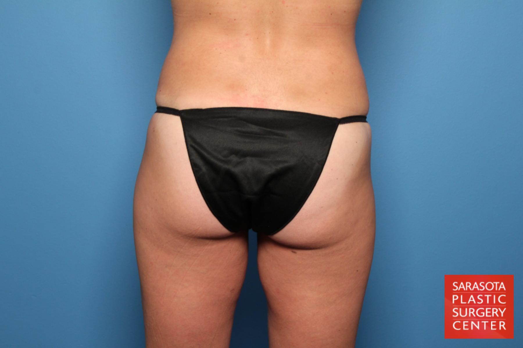 Liposuction: Patient 14 - After 4