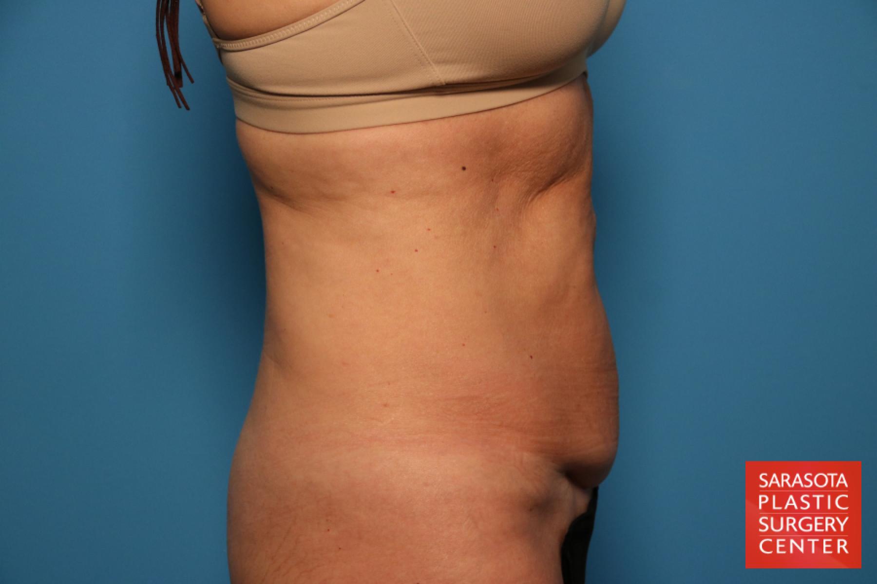 Mini Tummy Tuck: Patient 1 - Before and After 3